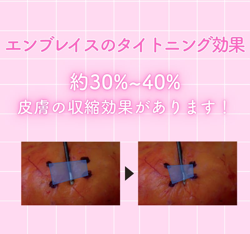 タイトニングの効果