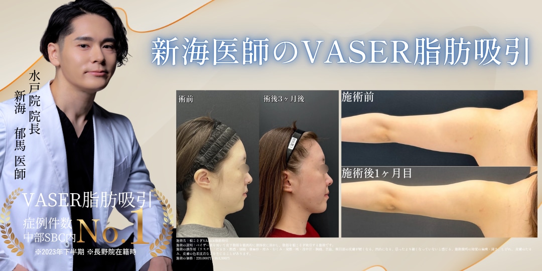 ベイザー脂肪吸引でほっそりナチュラルな二の腕に‼︎