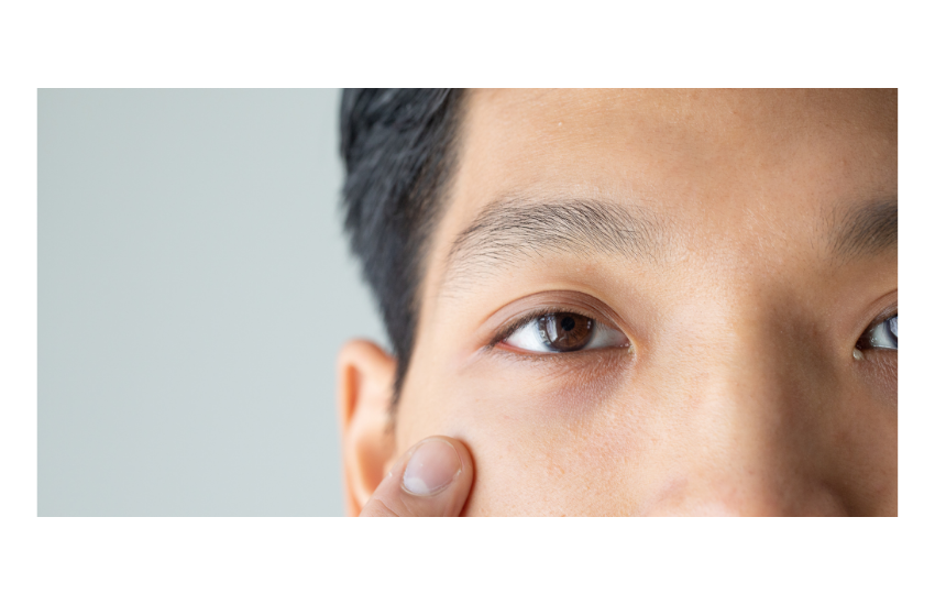 目の下の切らないクマ取り