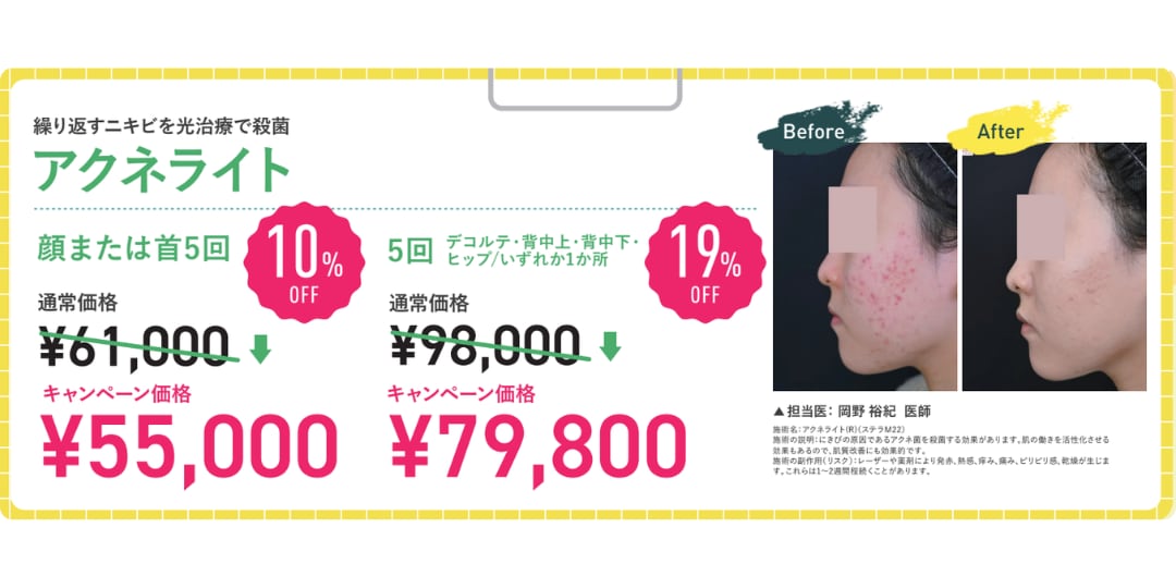 アクネライト