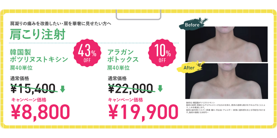 ボトックス（肩）