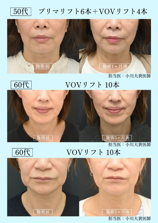 小川医師の糸リフト　整形感なくナチュラルにたるみ改善