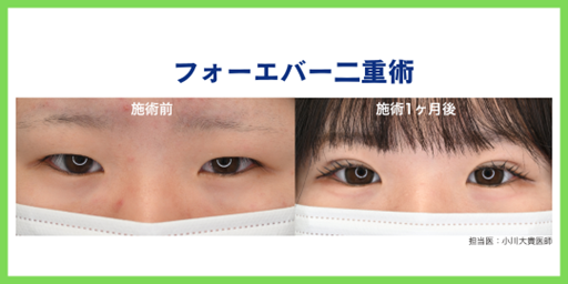 3位 フォーエバー二重術 
