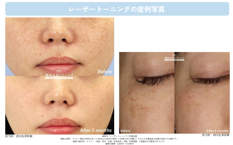 弱い出力の光を、繰り返し重ねていく施術