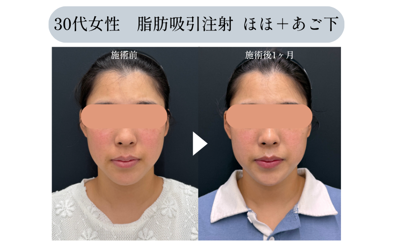痩せた実感があるのは、だいたい顔以外<br />
