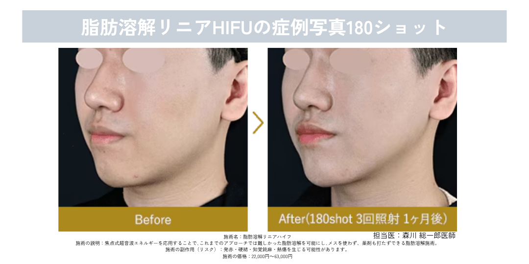 超音波の熱で、あご下とフェイスラインの脂肪に働きかける