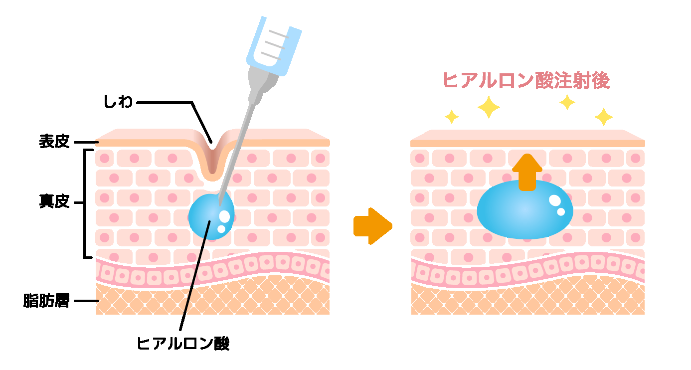 注入したその日から変化がわかる理由