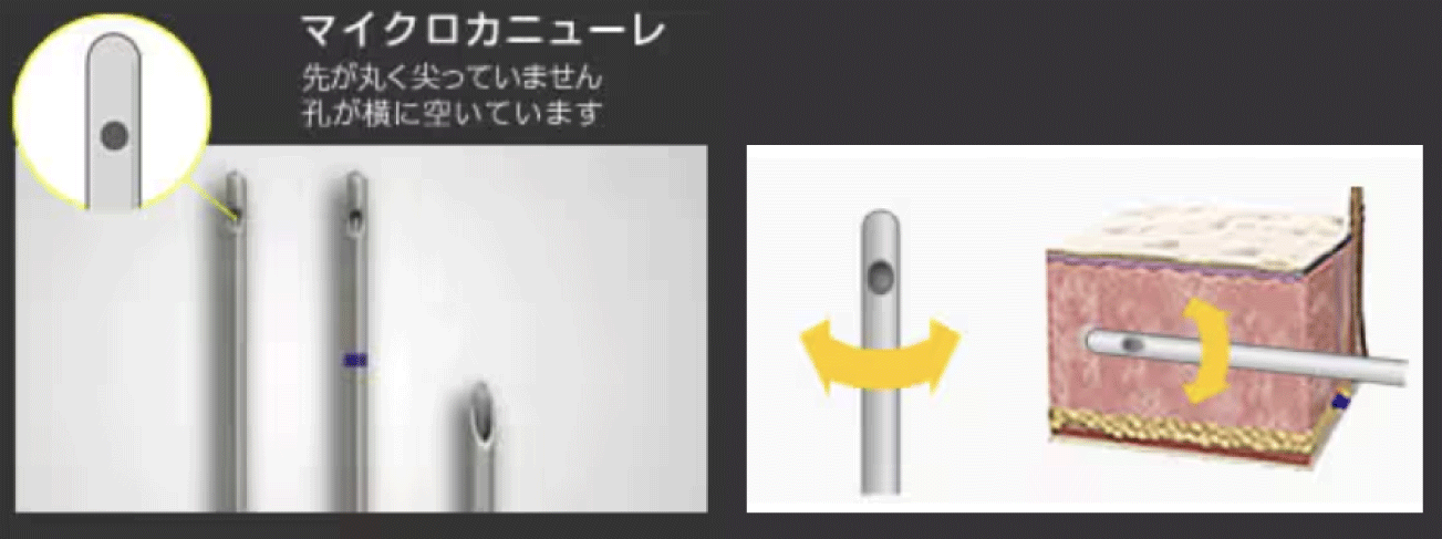内出血しにくいマイクロカニューレという針