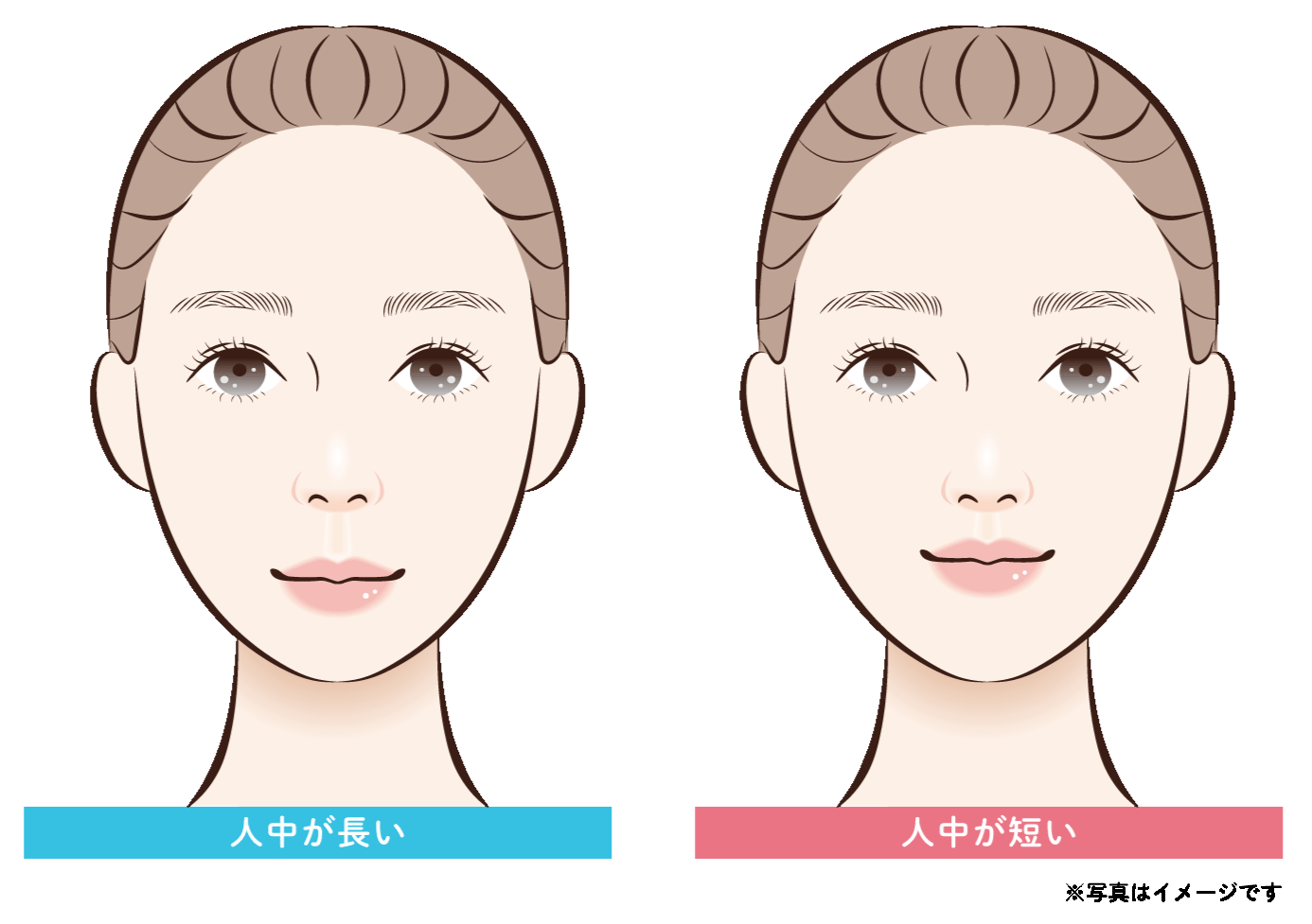 人中短縮ボトックス｜鼻の下の間延びを、切らずに