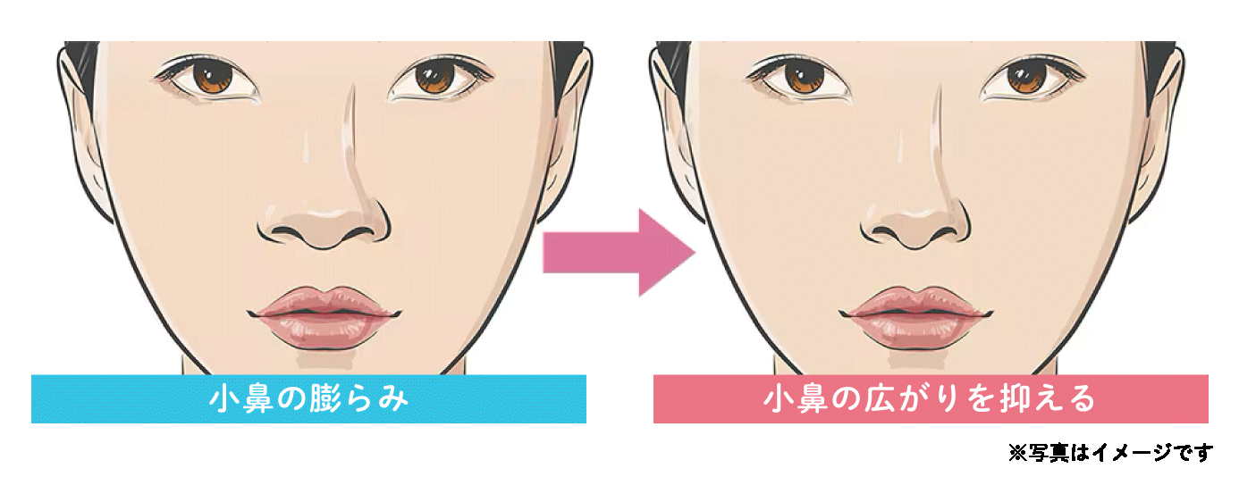 小鼻ボトックス｜笑ったときの広がりを抑える