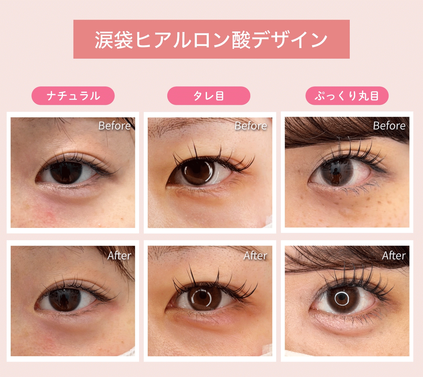 涙袋のデザイン｜ナチュラル・タレ目風・ぷっくり丸目