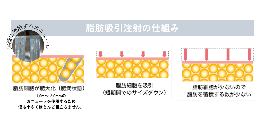 切らずに、脂肪そのものを抜いてしまう