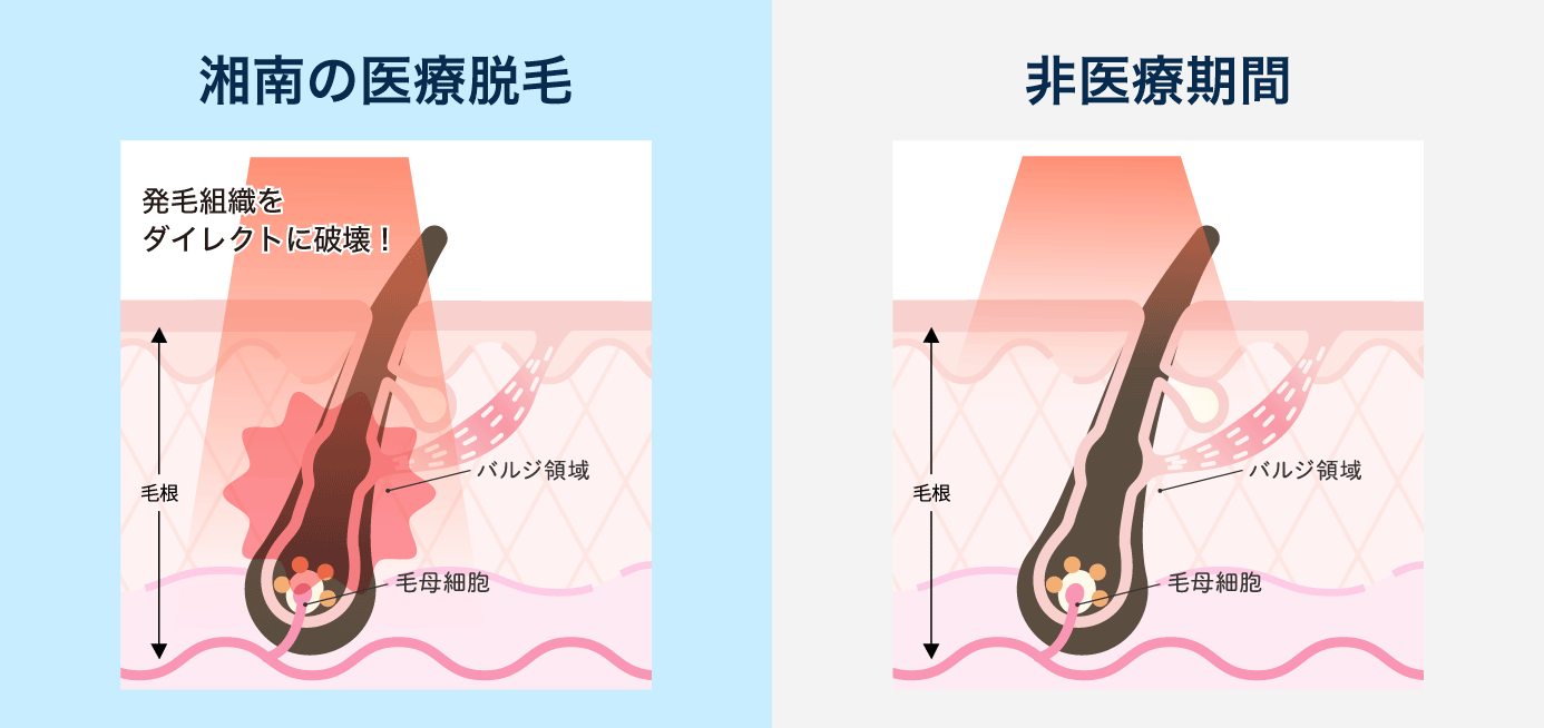 ■ 湘南の医療脱毛・非医療脱毛の特徴