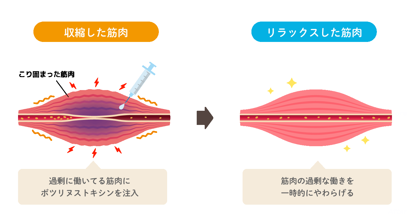 注射で一時的に、力の入り方をゆるめる