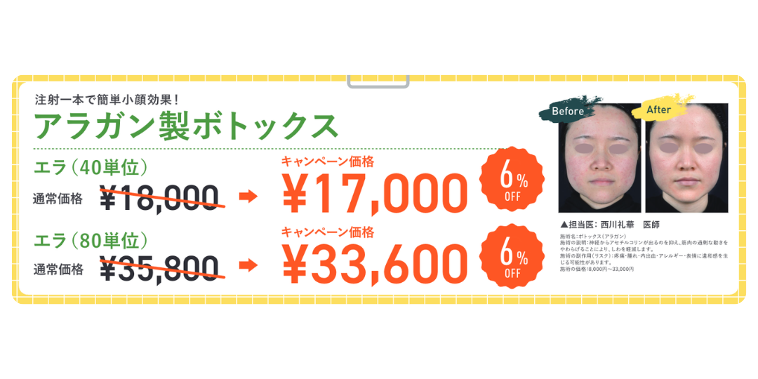 小顔効果もあり！！「ボトックス（エラ）」