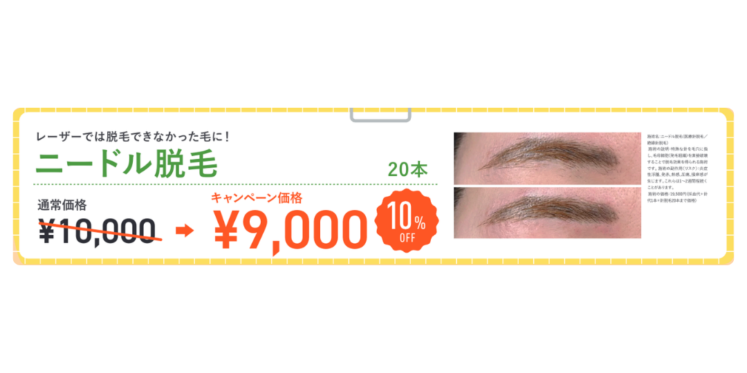 白髪や眉下の脱毛は「ニードル脱毛」