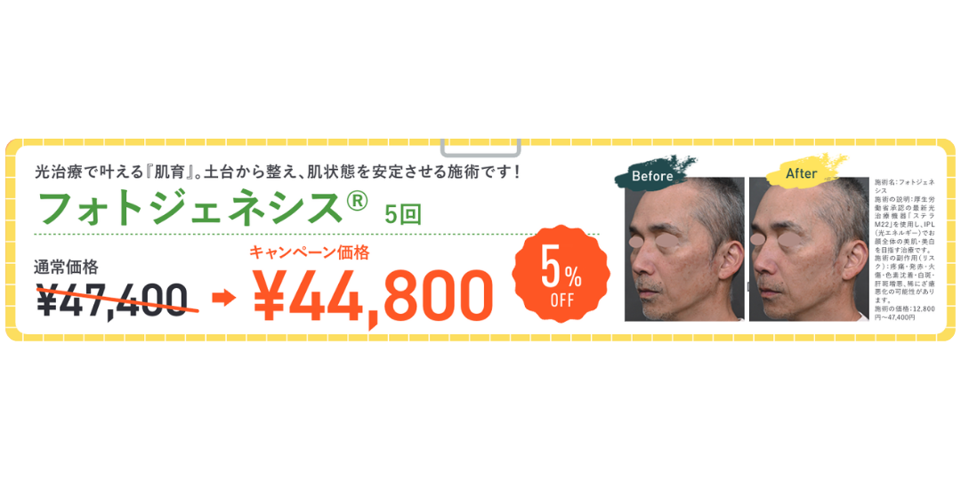 肝斑がある方も受けられる肌育施術「フォトジェネシス」