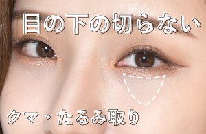 目の下の切らないクマ・たるみ（ふくらみ）取り