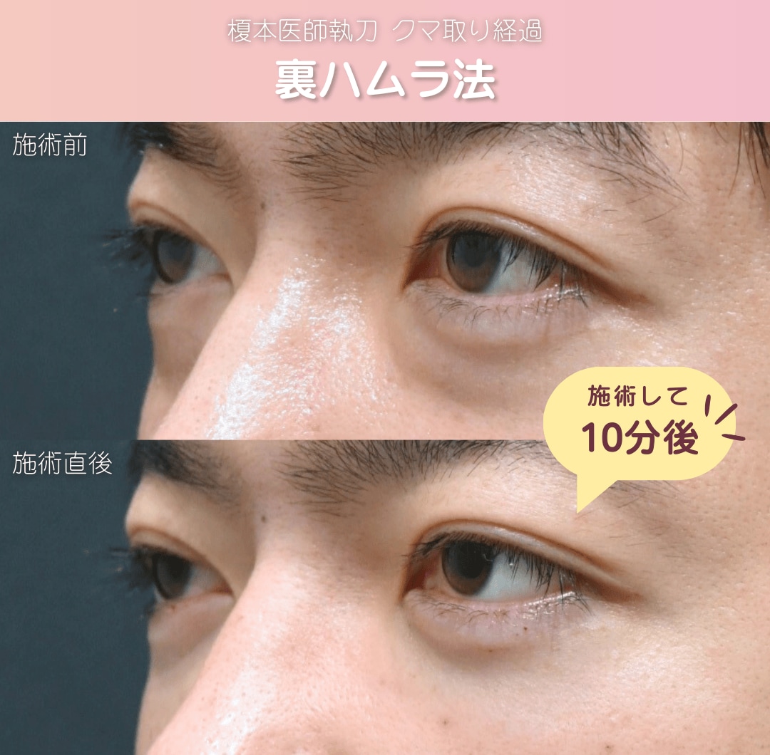 理由3：術後のダウンタイムを最小限に。丁寧さを極めた“こだわり施術”