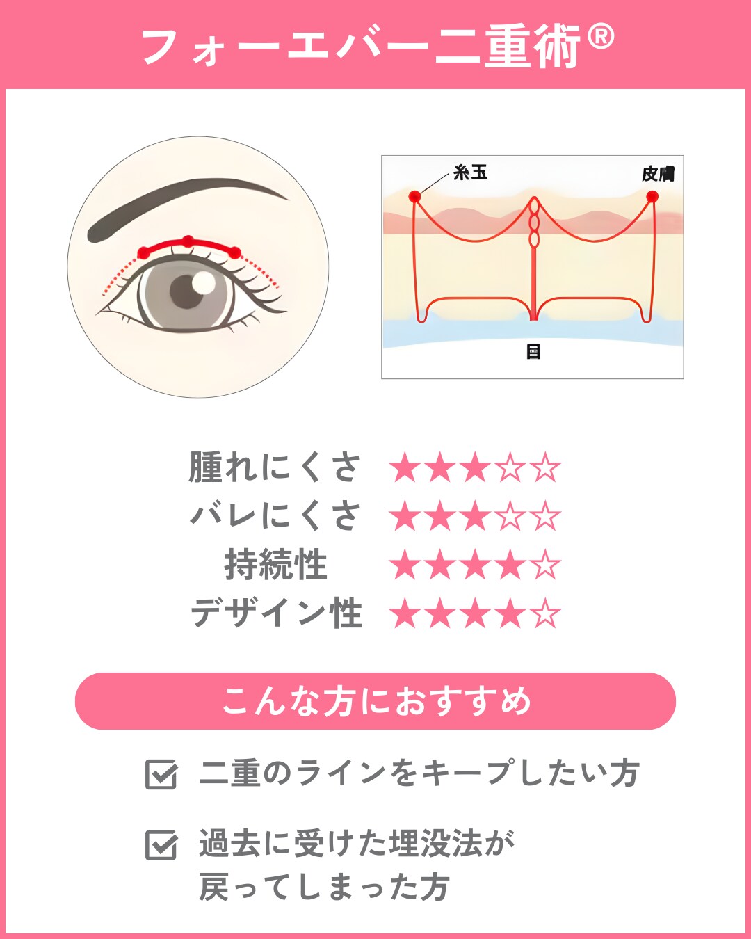  取れにくさ重視なら「フォーエバー二重術」