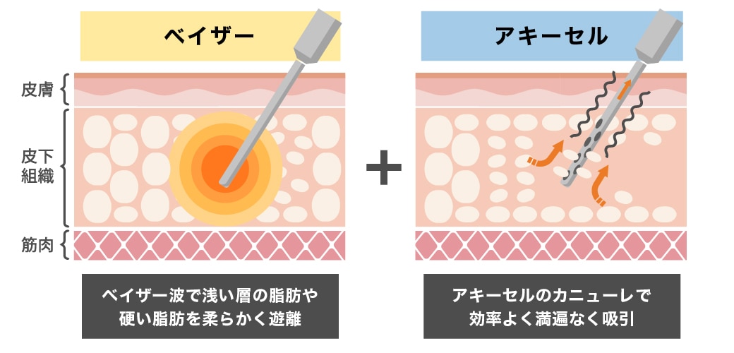 VASER脂肪吸引との併用がおすすめ