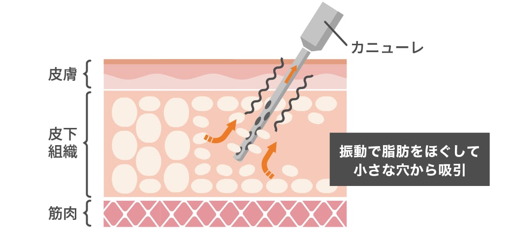 体に優しく効率的な脂肪吸引