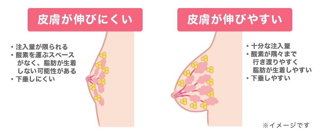 十分な空間があるので脂肪定着に最適!