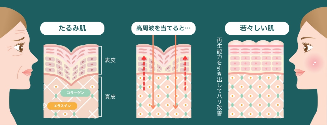 そもそも”高周波”って？