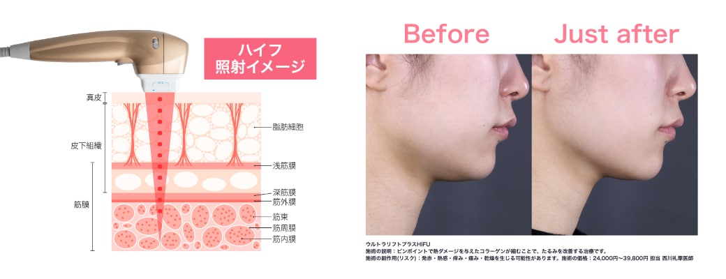 ハイフは「土台（SMAS筋膜）」からグッと引き上げます
