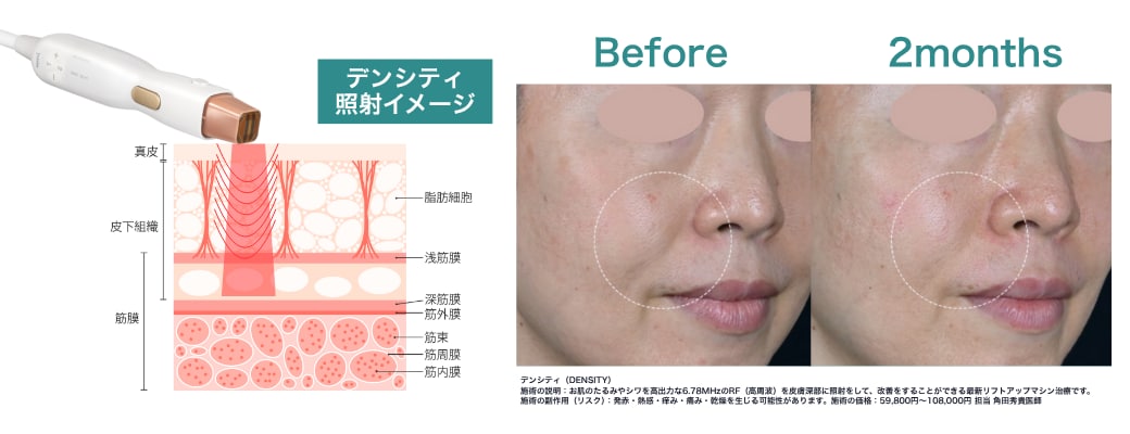 デンシティは”肌全体のゆるんだ感じを引き締めます