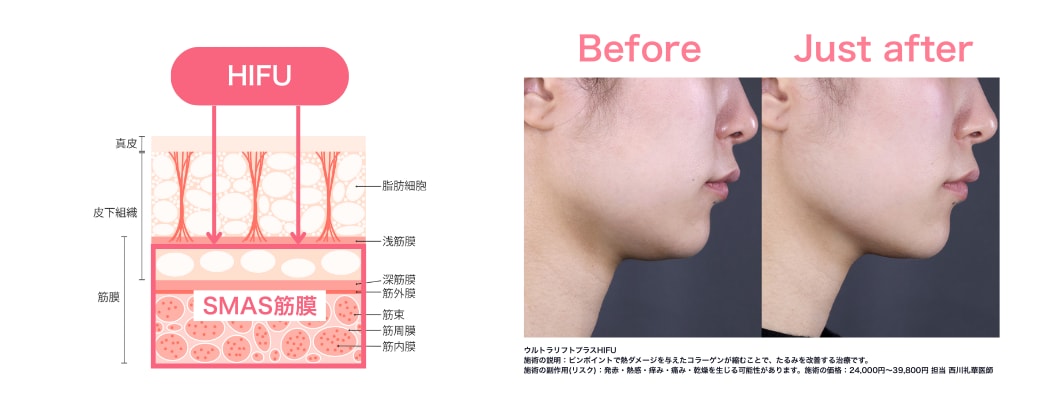 ハイフは「土台（SMAS筋膜）」からグッと引き締めます