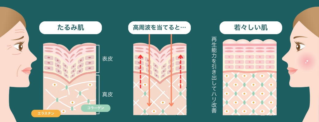 そもそも”高周波”って？