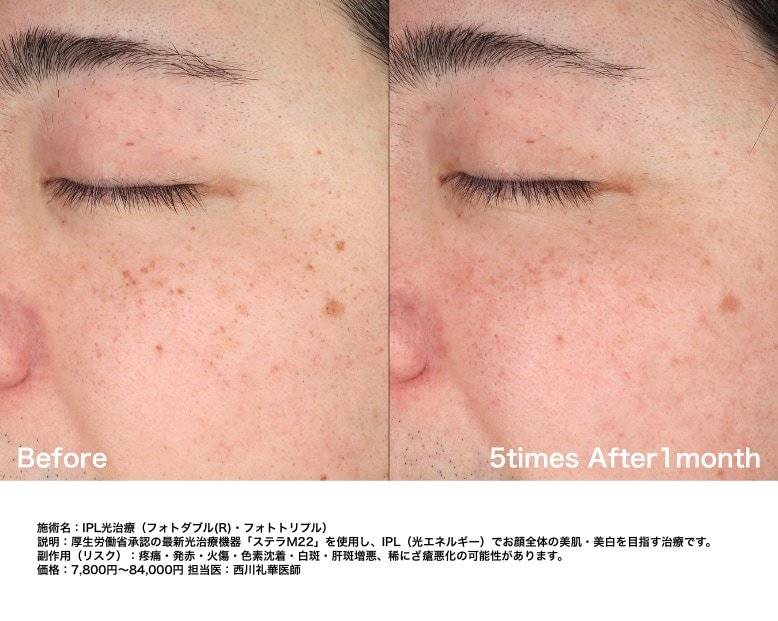 ポツポツシミが全体的に薄く！