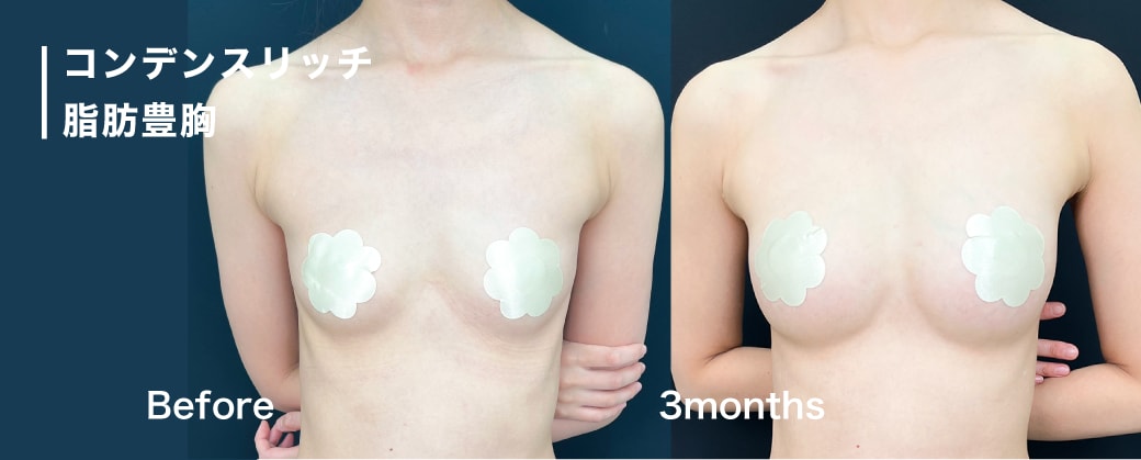 デコルテ豊胸の魅力