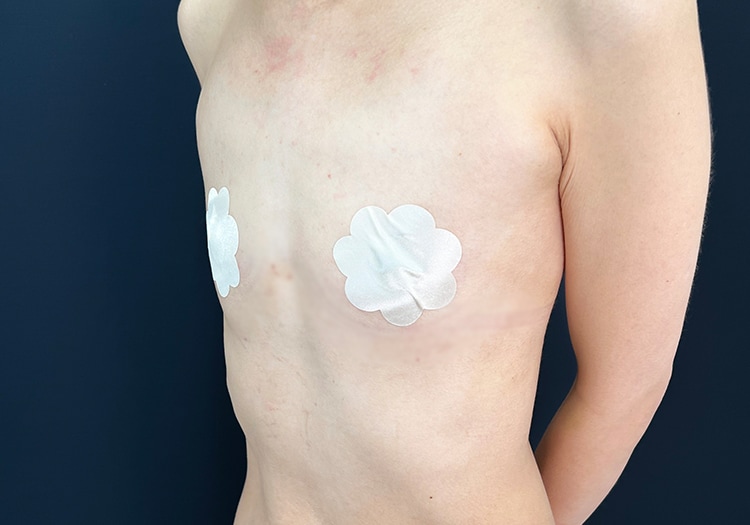 藤井医師のデコルテ豊胸