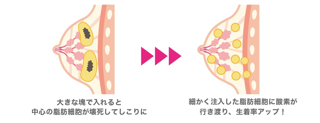 「しこり」を作らせない精密な注入技術<br />
