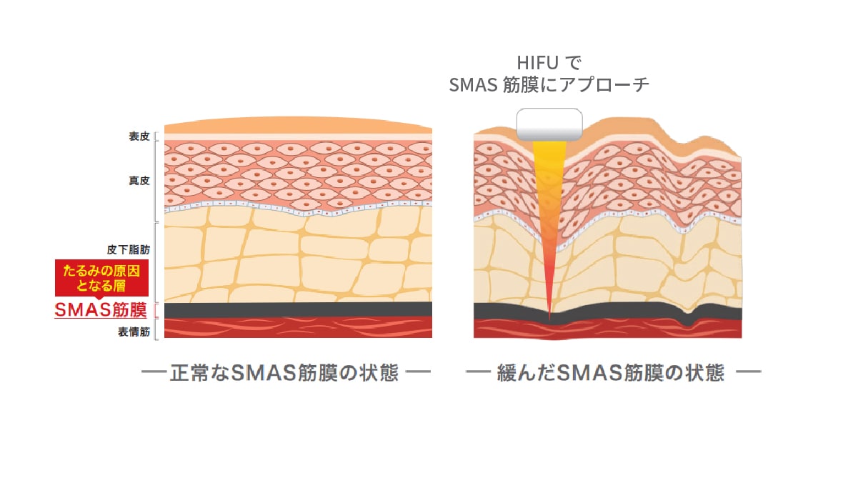 【Step2】ウルトラリフトプラスHIFUで深層筋膜を引き締め