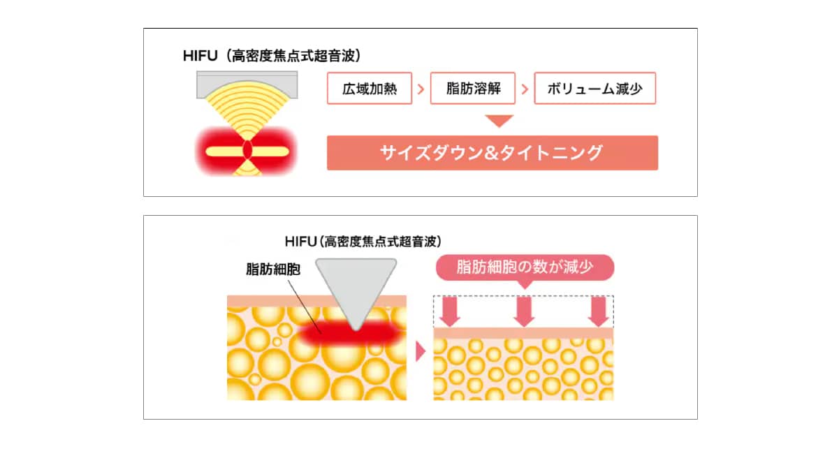 【Step1】脂肪溶解リニアHIFUで輪郭のもたつき・脂肪をボリュームダウン