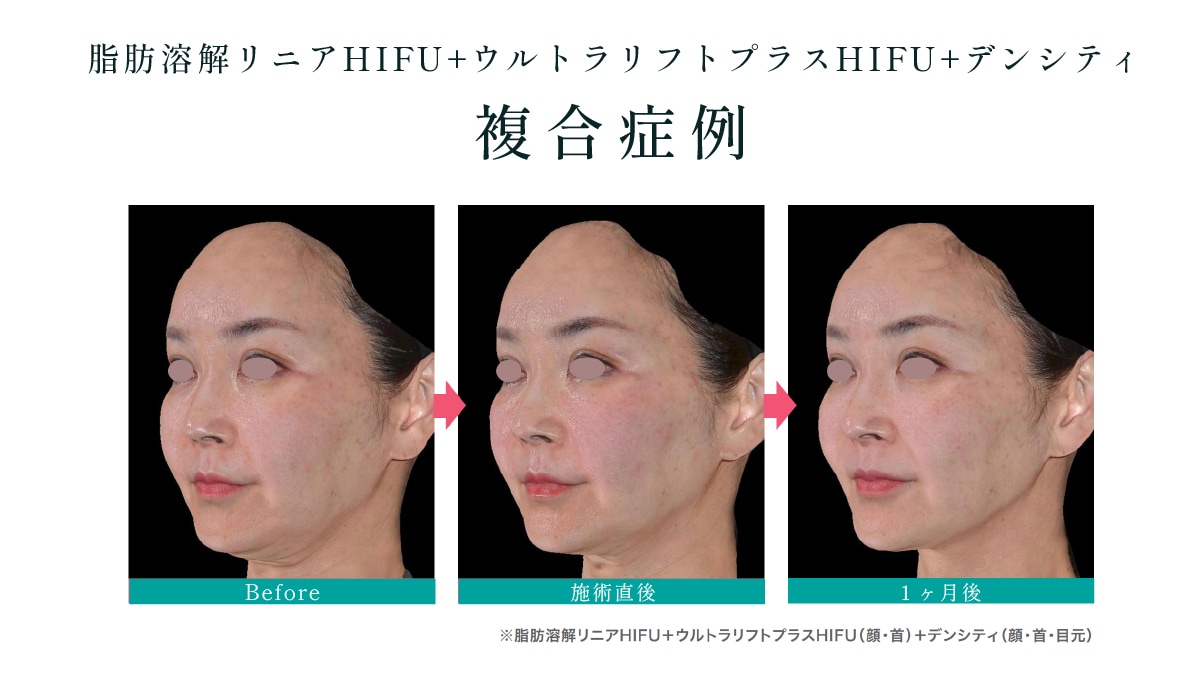 脂肪・筋膜・真皮に同時に効かせる同日セット施術のメリット