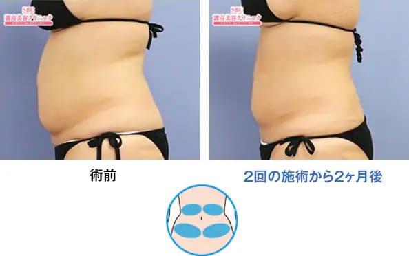 施術中の痛みや内出血・腫れ・知覚鈍麻のリスク