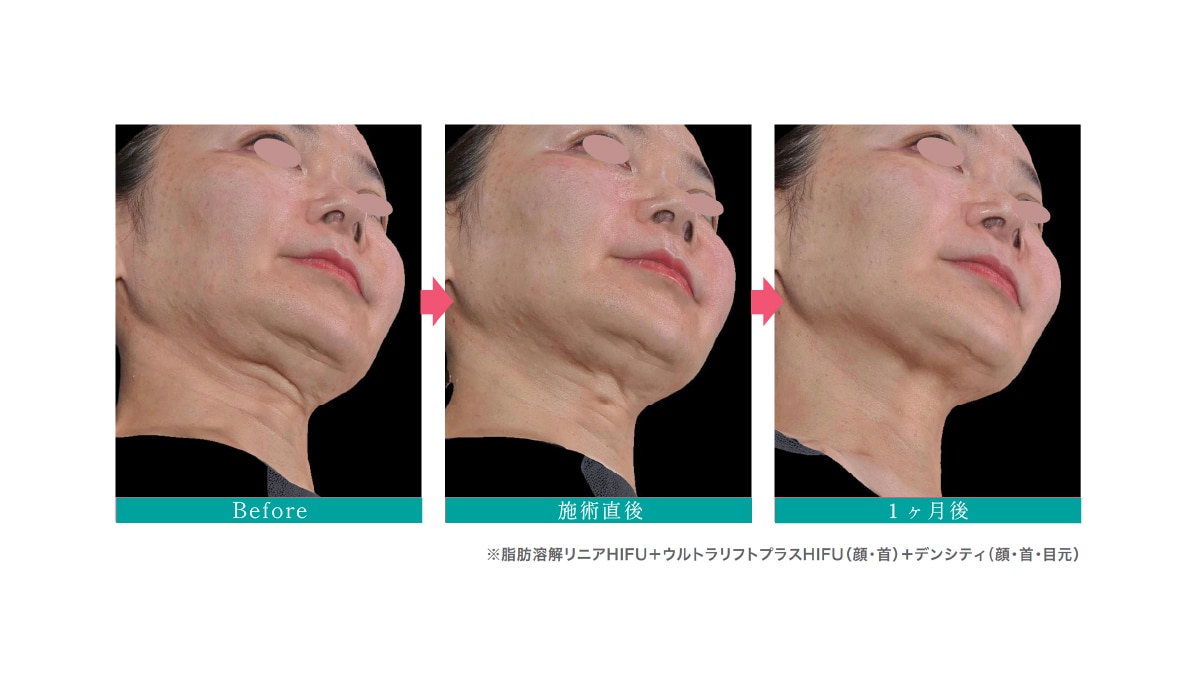 効果の実感時期と持続期間について