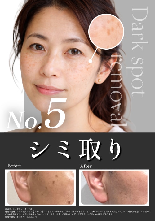 【 シミ取り】湘南美容のシミ取り2,680円〜