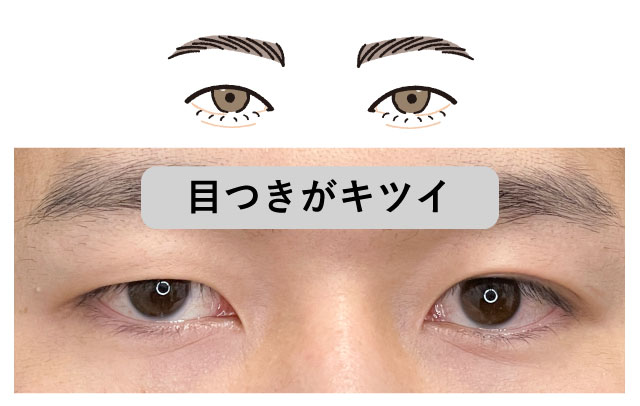 (男性に多い悩み)目つきを柔らかくしたい