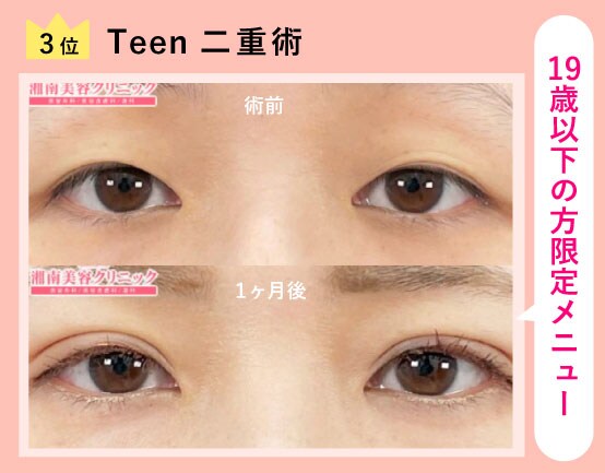 3位 :Teen二重術