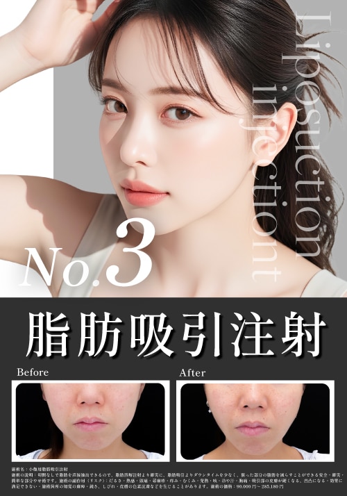 【脂肪吸引注射】韓流小顔注射！韓国では当たり前の小顔治療