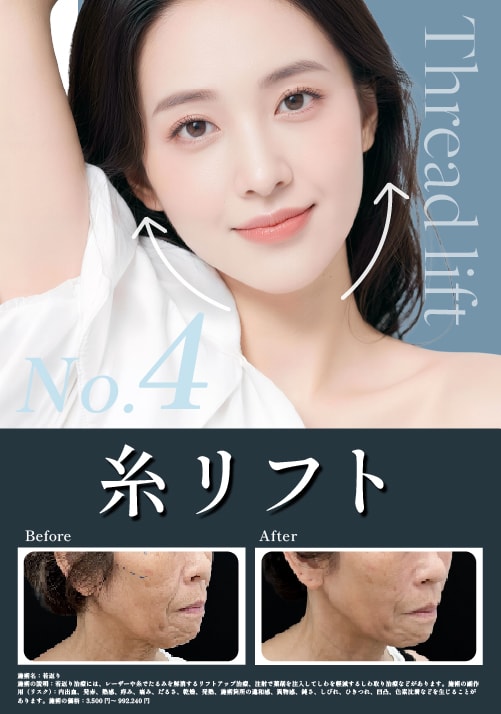 【糸リフト】お顔のたるみを引き上げ、速攻若返り！