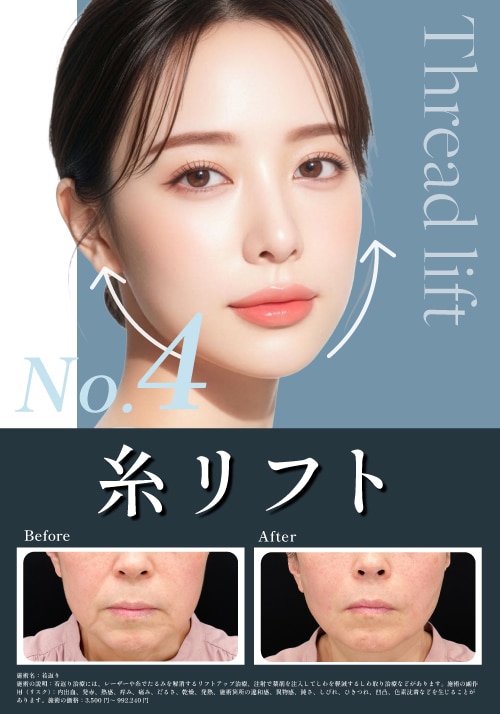 【糸リフト】お顔のたるみを引き上げ、速攻若返り！