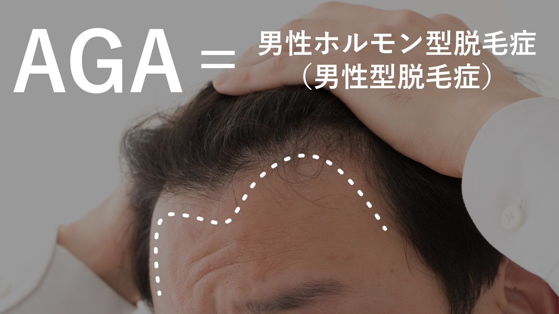 約1,200万人が悩むAGA