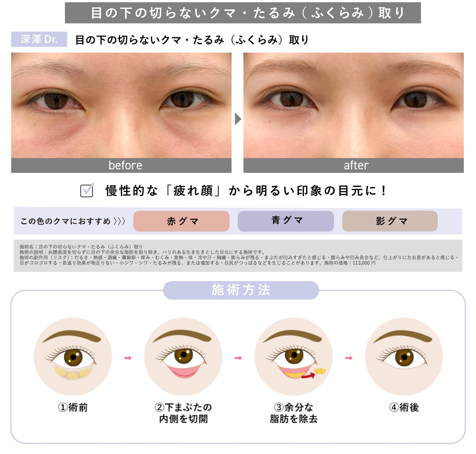 目の下の切らないクマ・たるみ（ふくらみ）取り