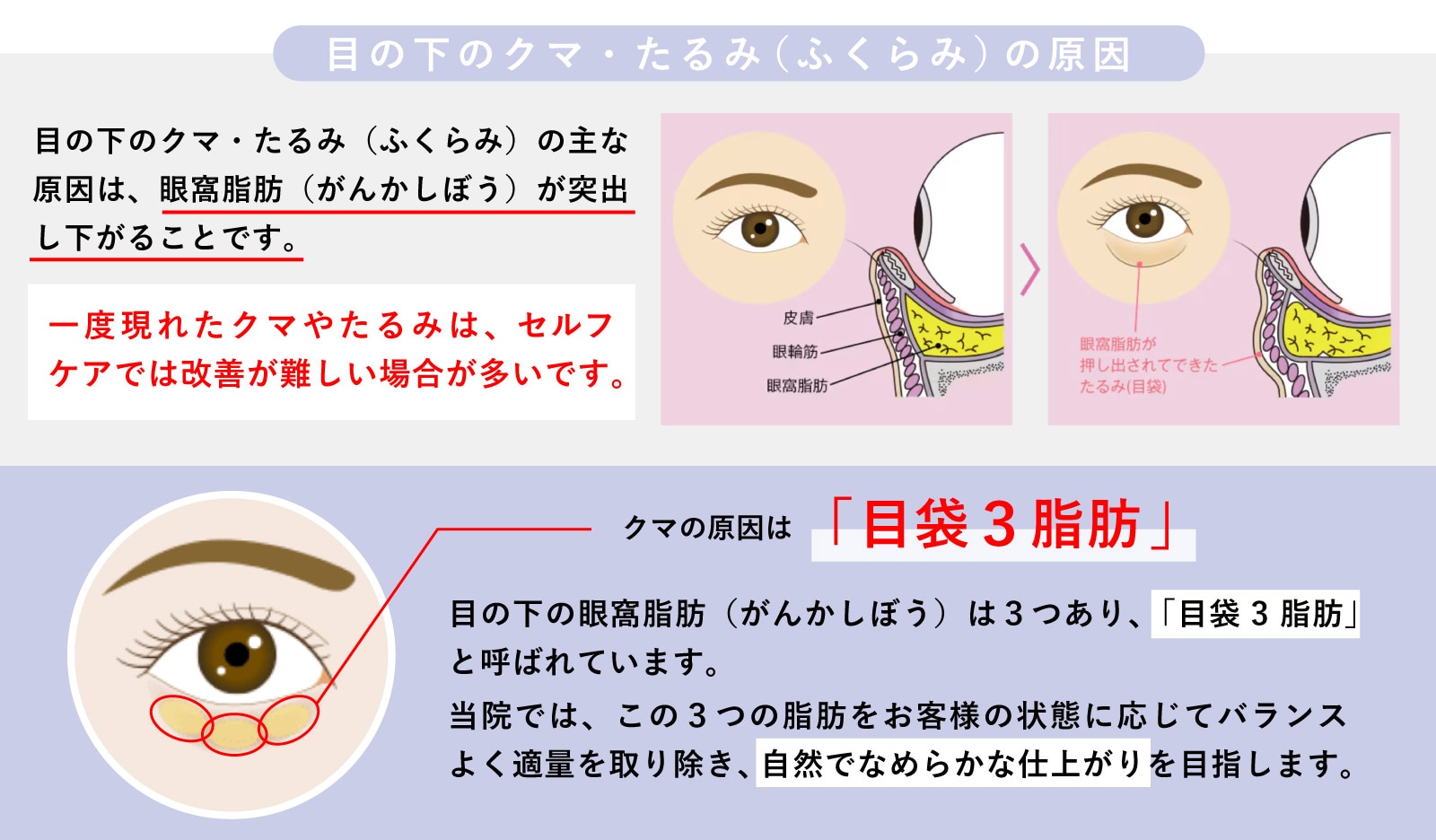 クマの原因は瞼の内側にある『目袋３脂肪』